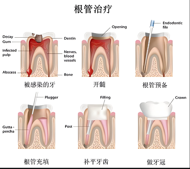 根管治疗适用人群是哪些?